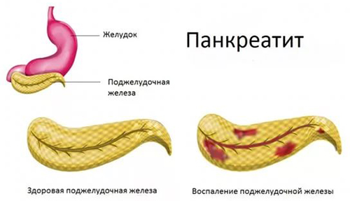 Панкреатит