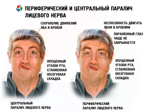 Парез лицевого нерва