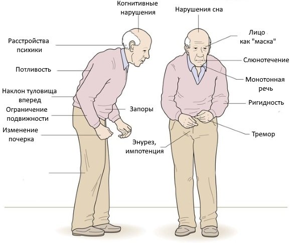 Паркинсонизм