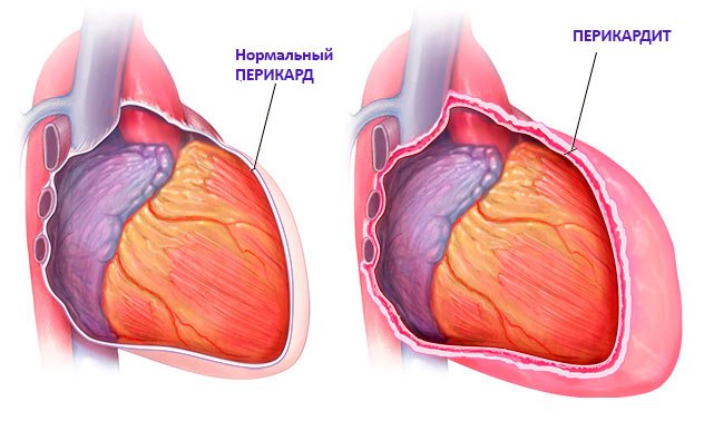 Перикардит