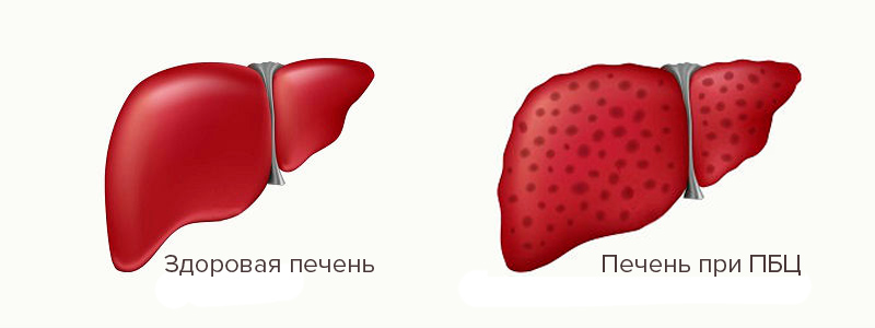 Билиарный цирроз