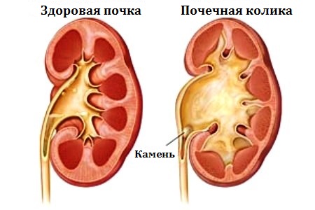 Почечная колика