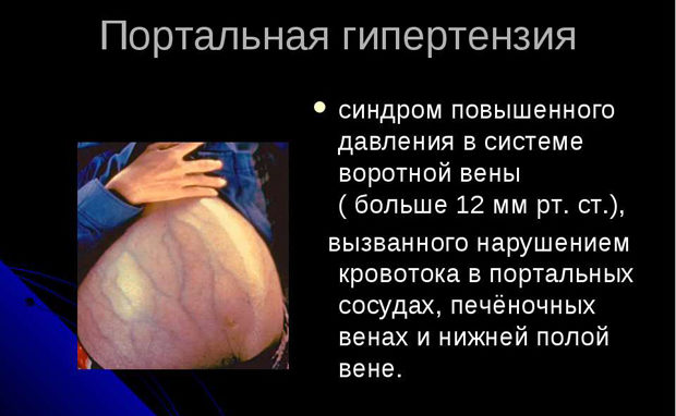 Портальная гипертензия