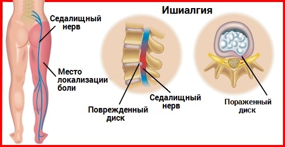 Ишиалгия