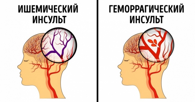 Инсульт