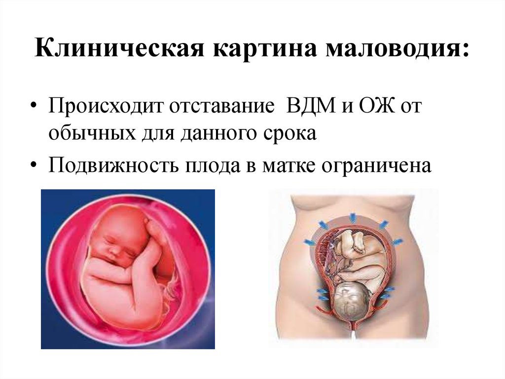 Олигогидрамнион