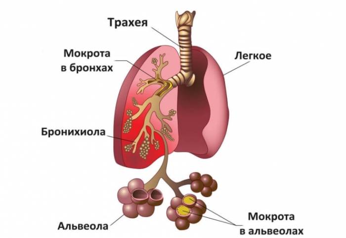 Пневмония