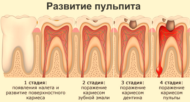 Пульпит