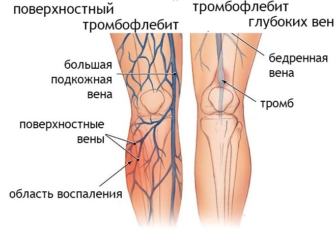 Тромбофлебит