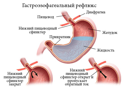 Гастроэзофагеальный рефлюкс