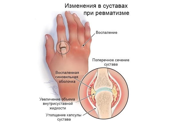 Ревматизм