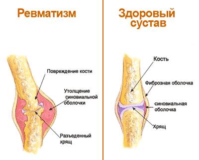 Ревматизм