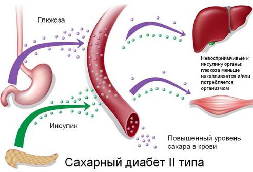 Сахарный диабет