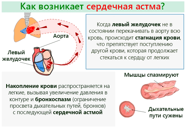 Сердечная астма