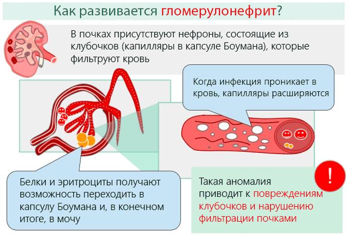 Гломерулонефрит