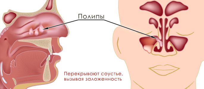 Полипозный синусит
