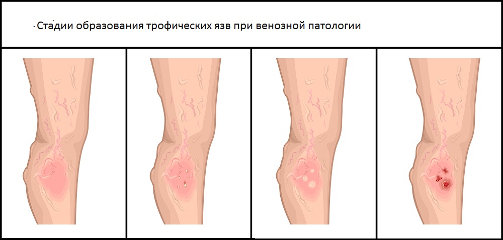 Стадии образования трофических язв