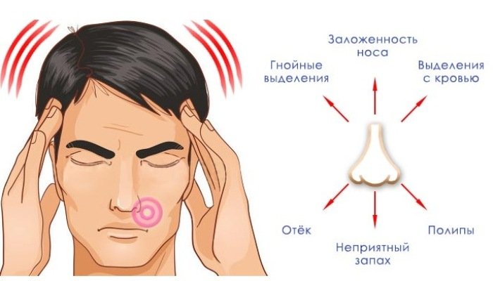 Симптомы пансинусита