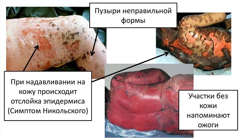 Синдром Лайелла