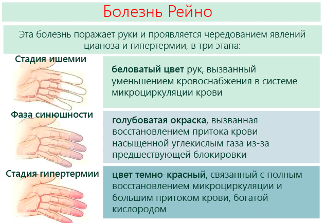 Синдром Рейно