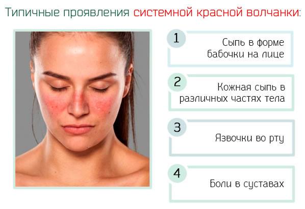 Системная красная волчанка