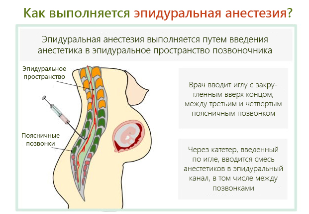 Проведение эпидуральной анестезии