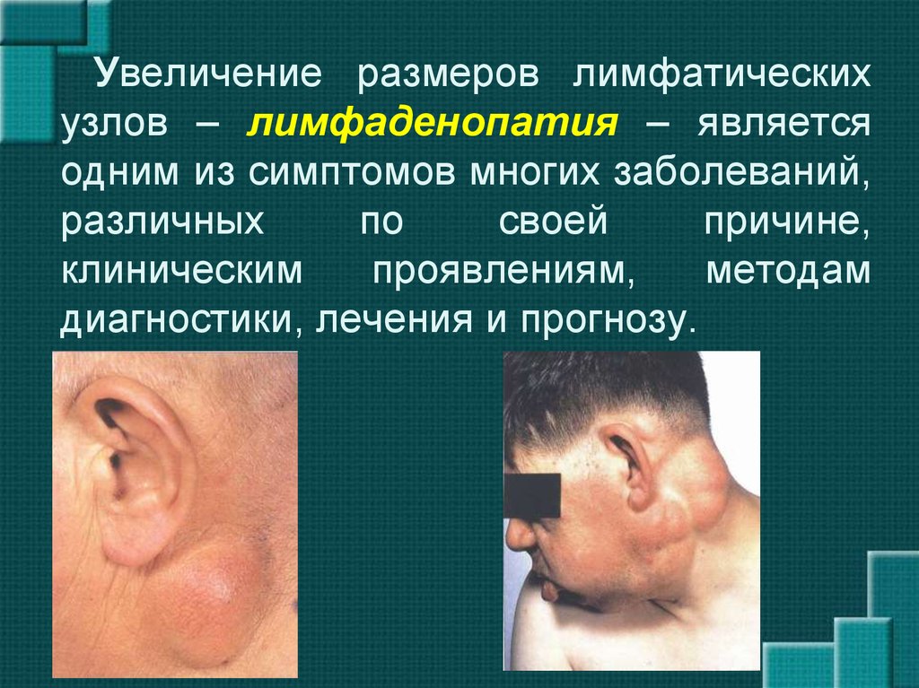 Лимфаденопатия