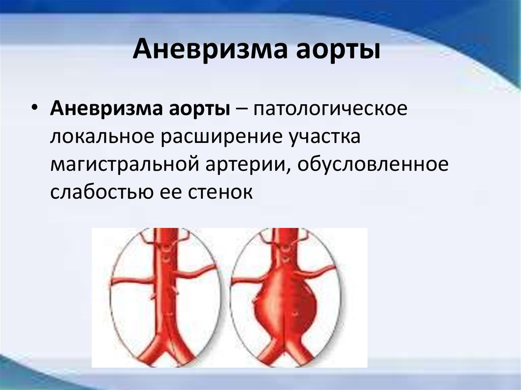 Аневризма