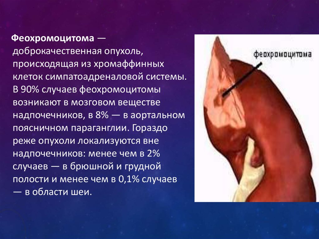 Феохромоцитома