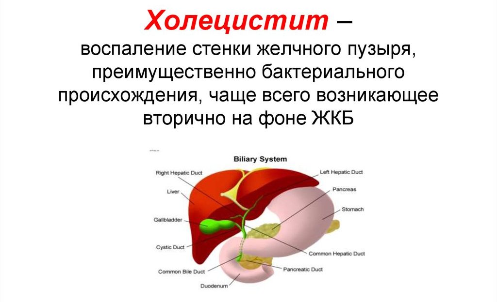 Холецистит