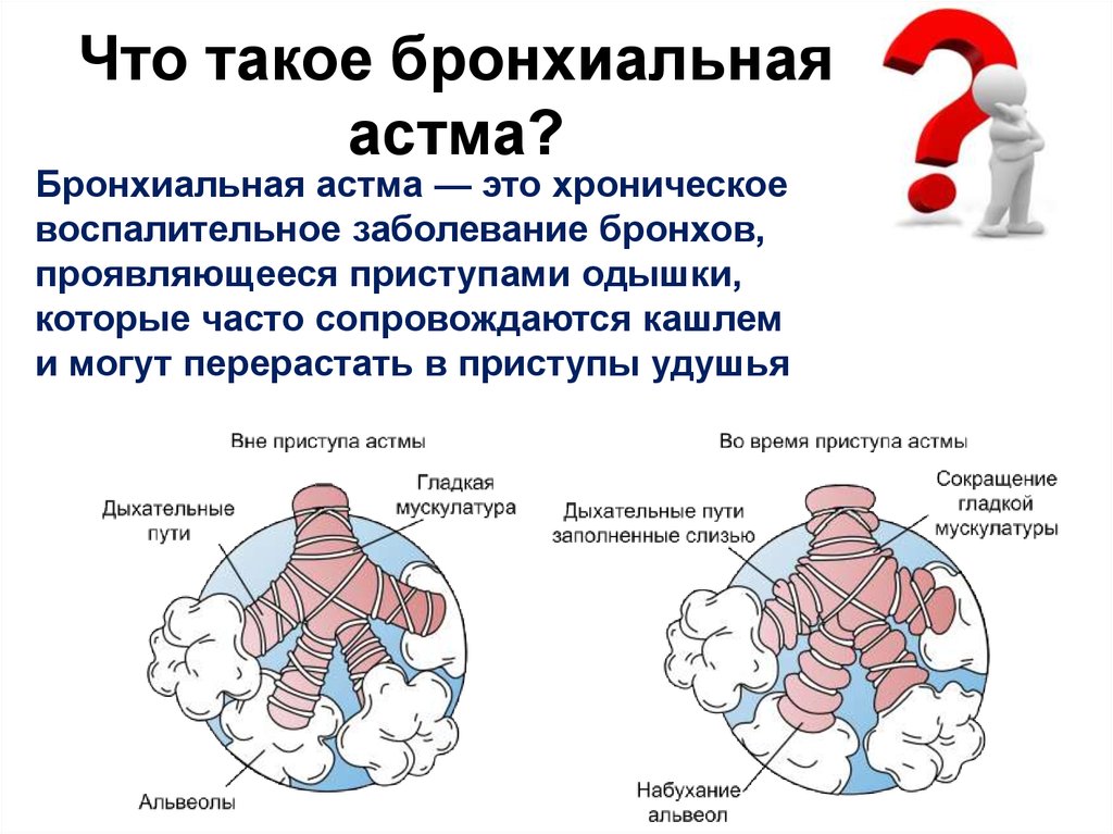 Бронхиальная астма
