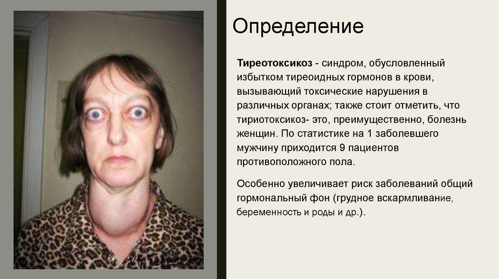 Тиреотоксикоз 