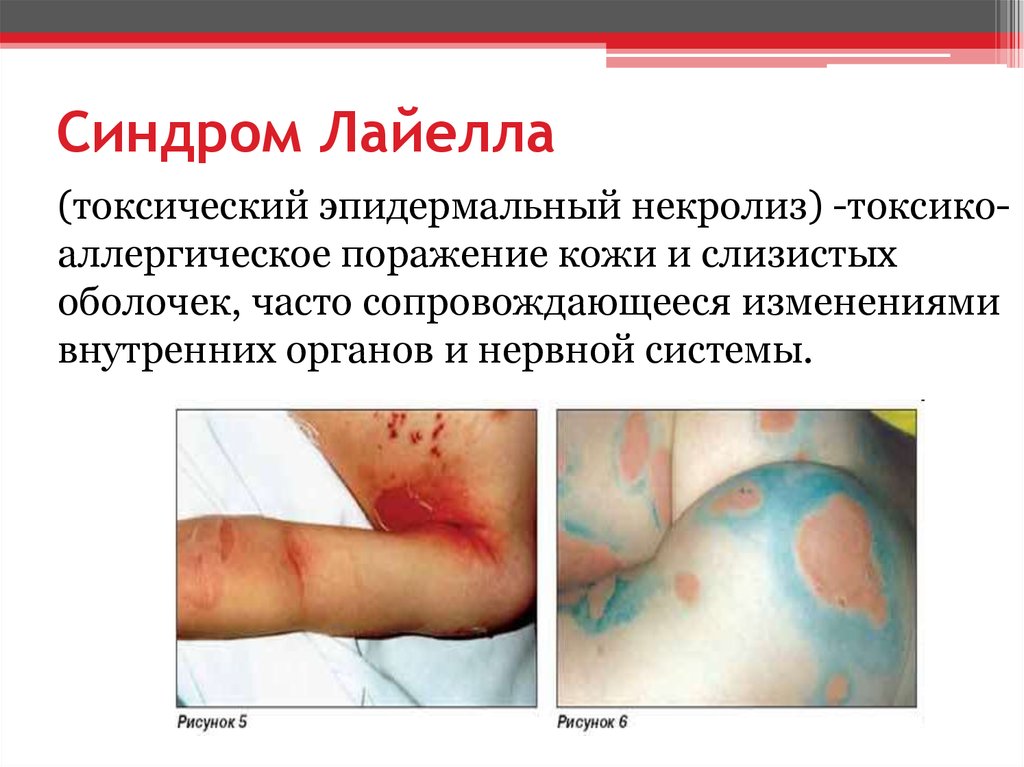 Синдром Лайелла