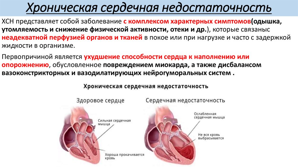 ХСН