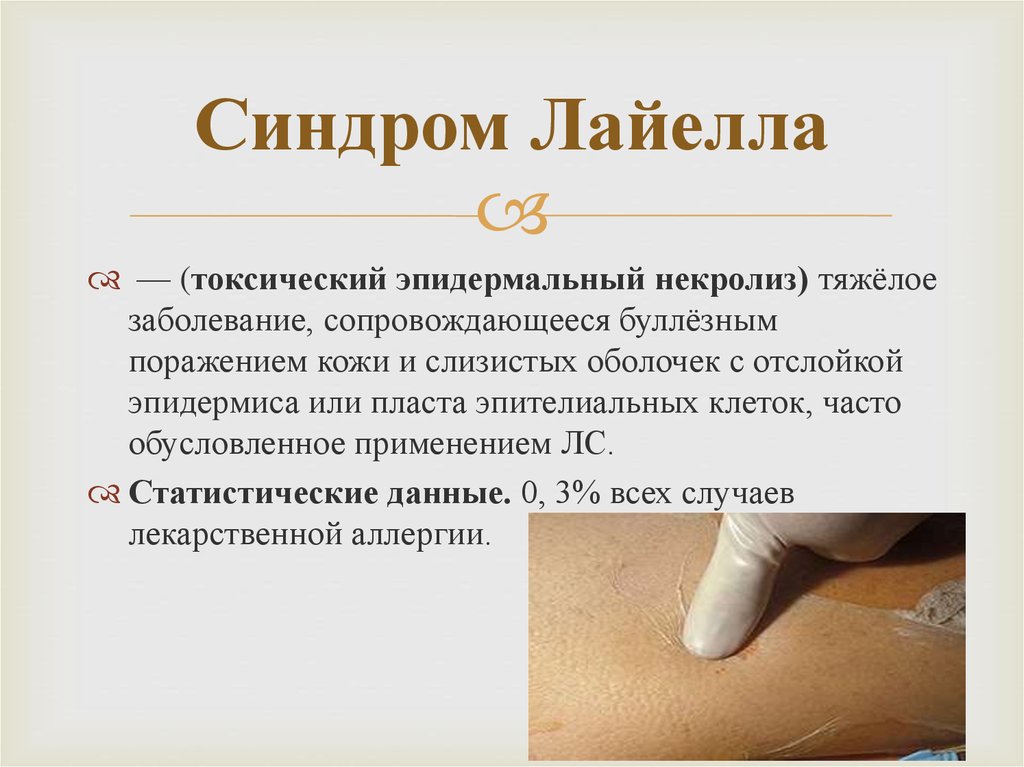 Синдром Лайелла