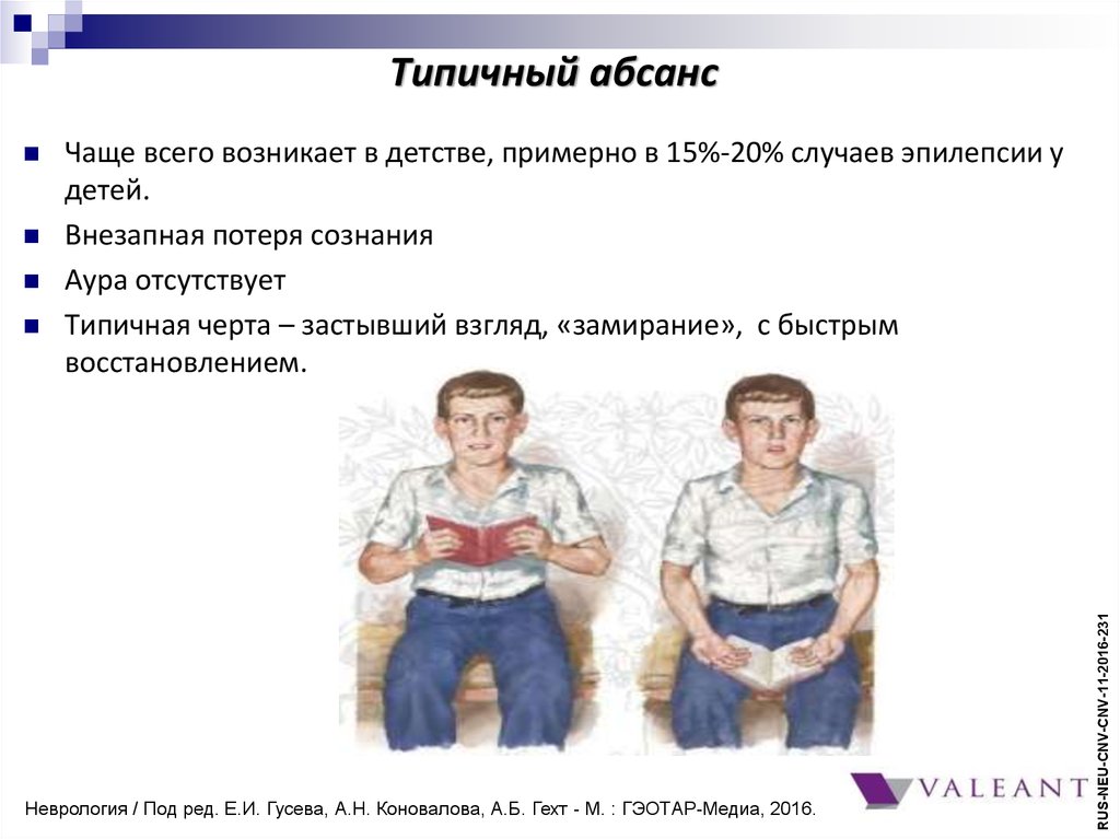 Симптоматика типичного абсанса