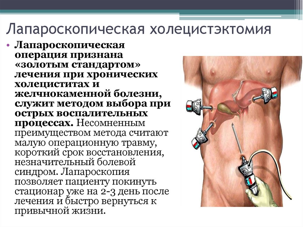 Холецистэктомия