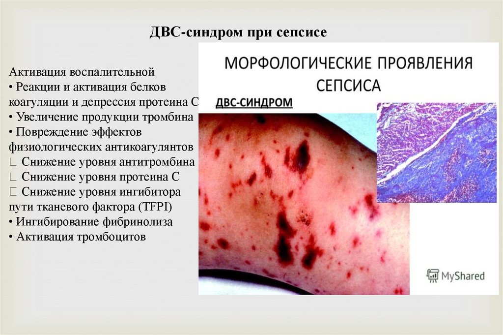 ДВС синдром