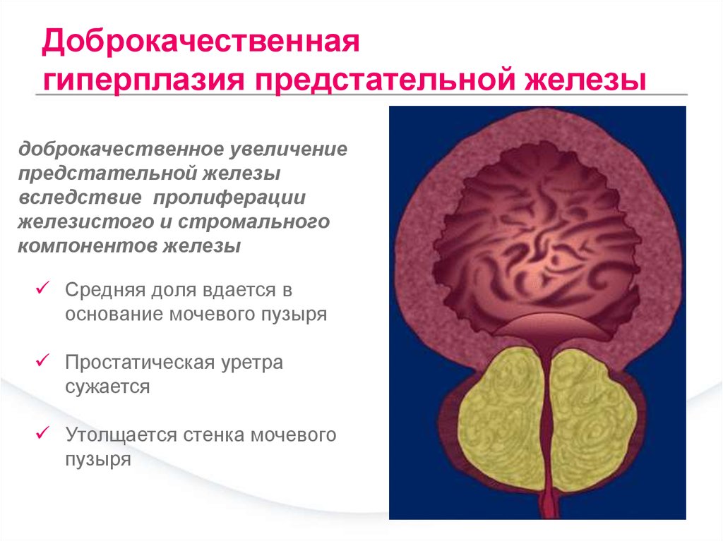 Гиперплазия предстательной железы