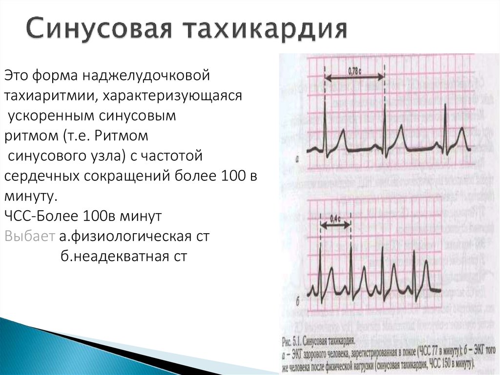 Синусовая тахикардия 