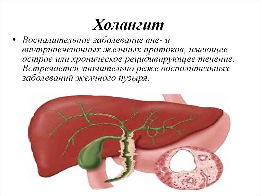 Холангит