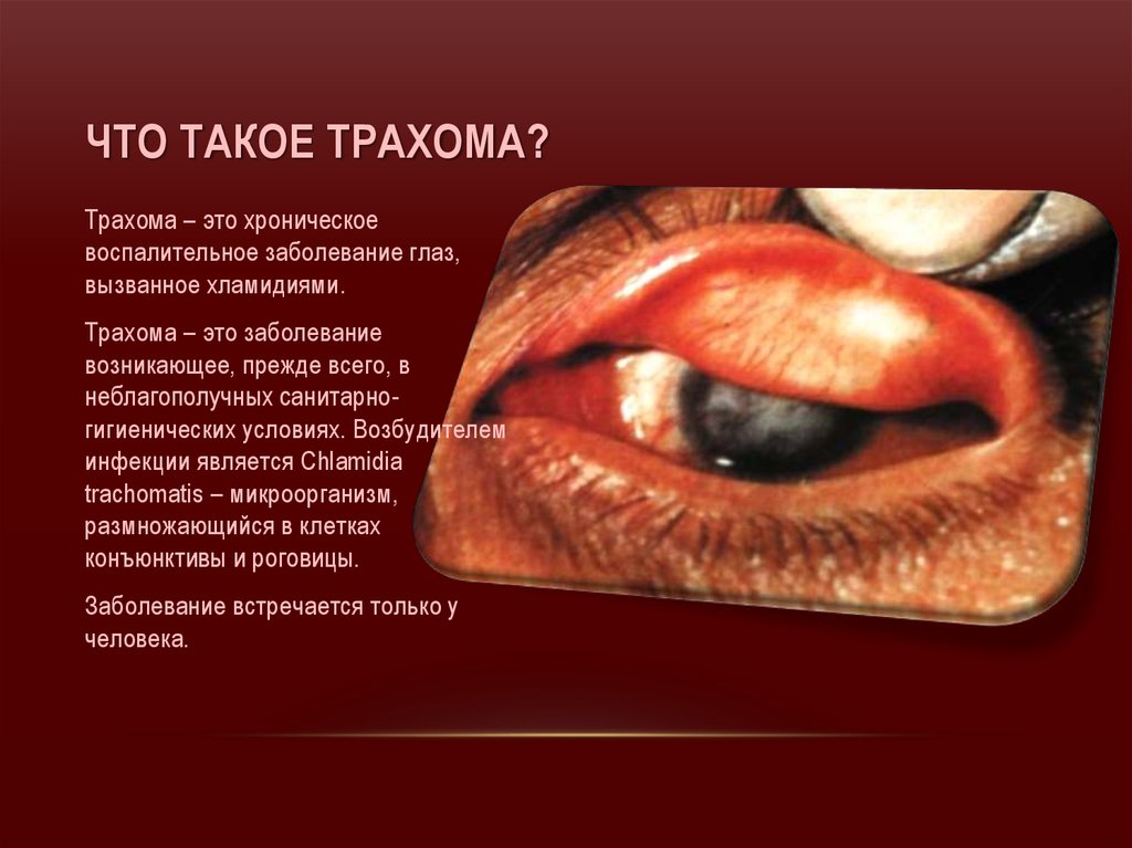 Трахома