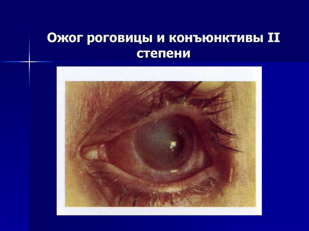 Ожог роговицы 