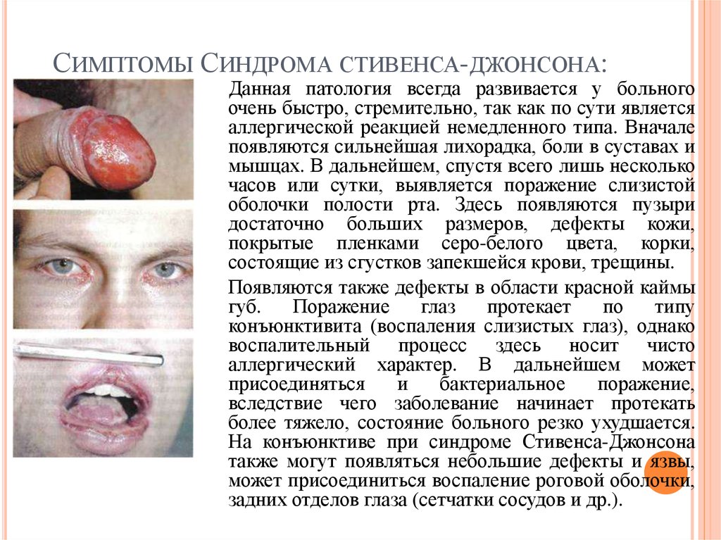 Симптомы диндрома Стивенса-Джонсона