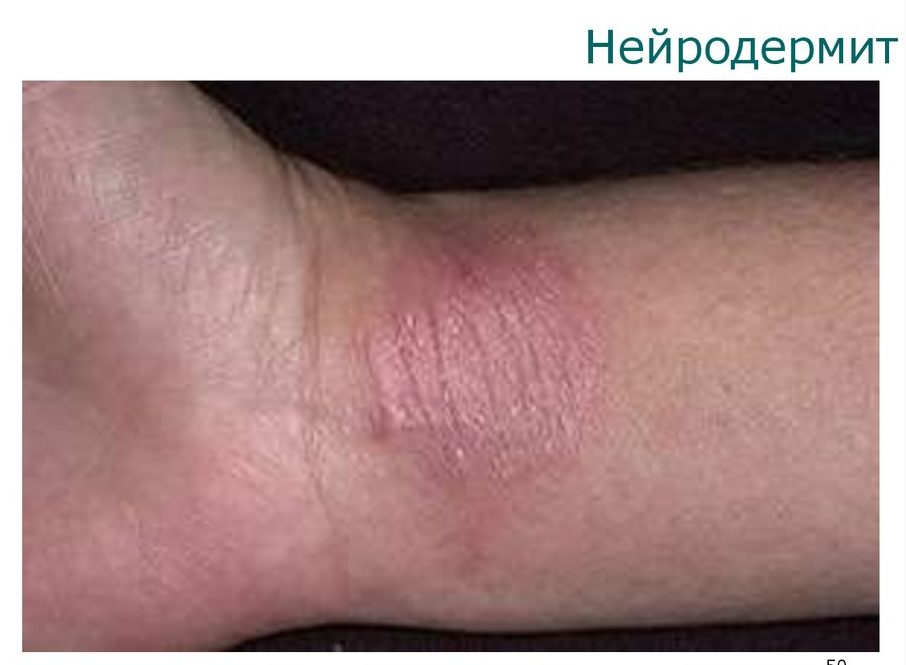 Нейродермит