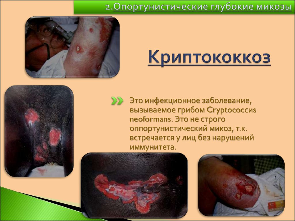 Криптококкоз