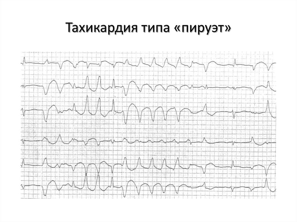 Тахикардия типа «пируэт»