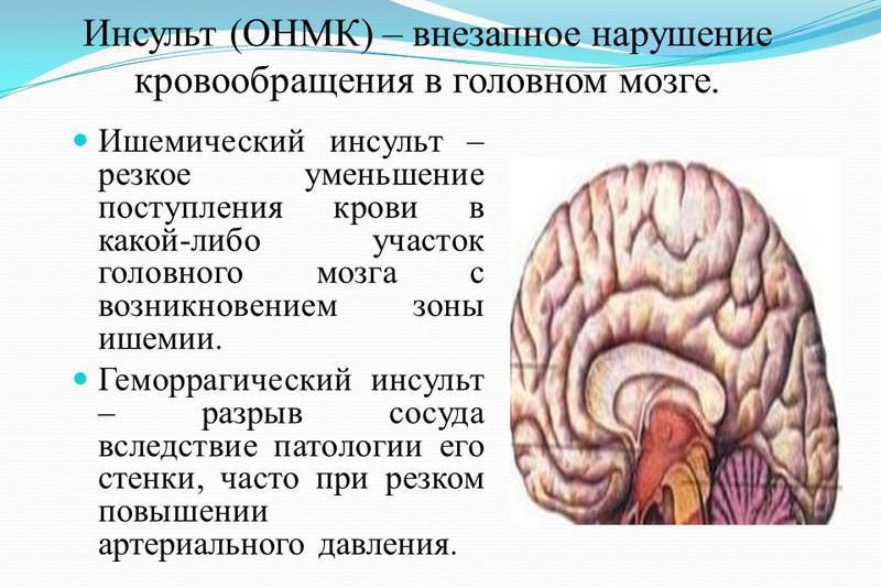 ОНМК