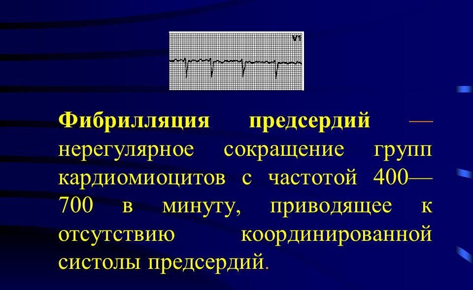 Фибрилляция предсердий