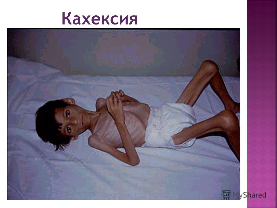 Кахексия